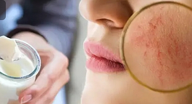 Egzamayı yok ediliyor! Bağırsağı, ve cildi temizleyen reçete